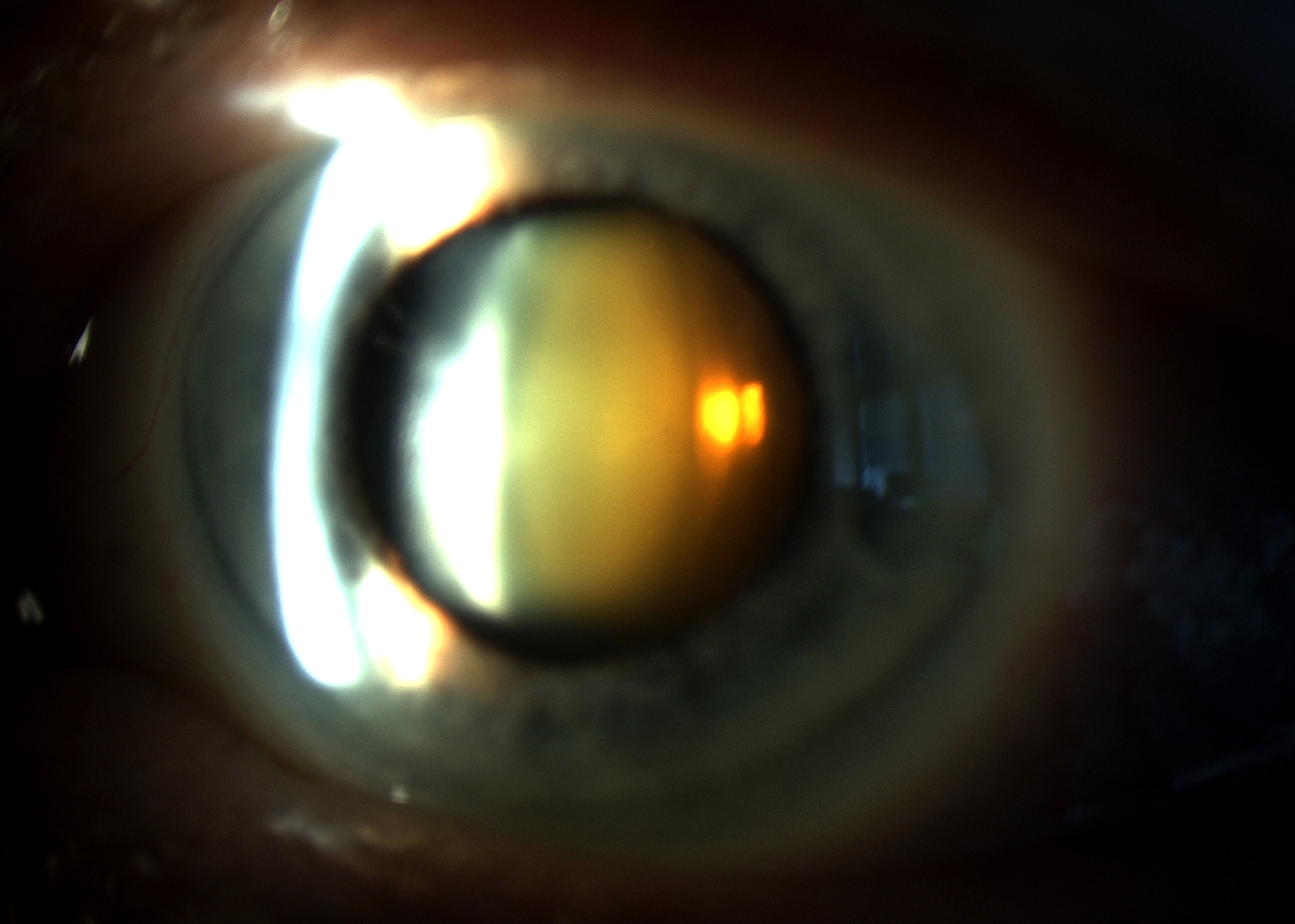Eyecare Blog - Cataracts and Cataract Treatments & Effects 